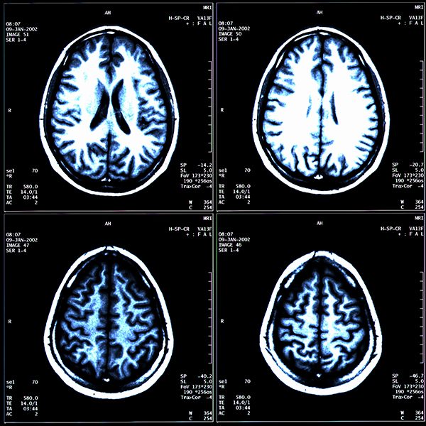 Brain MRI scans