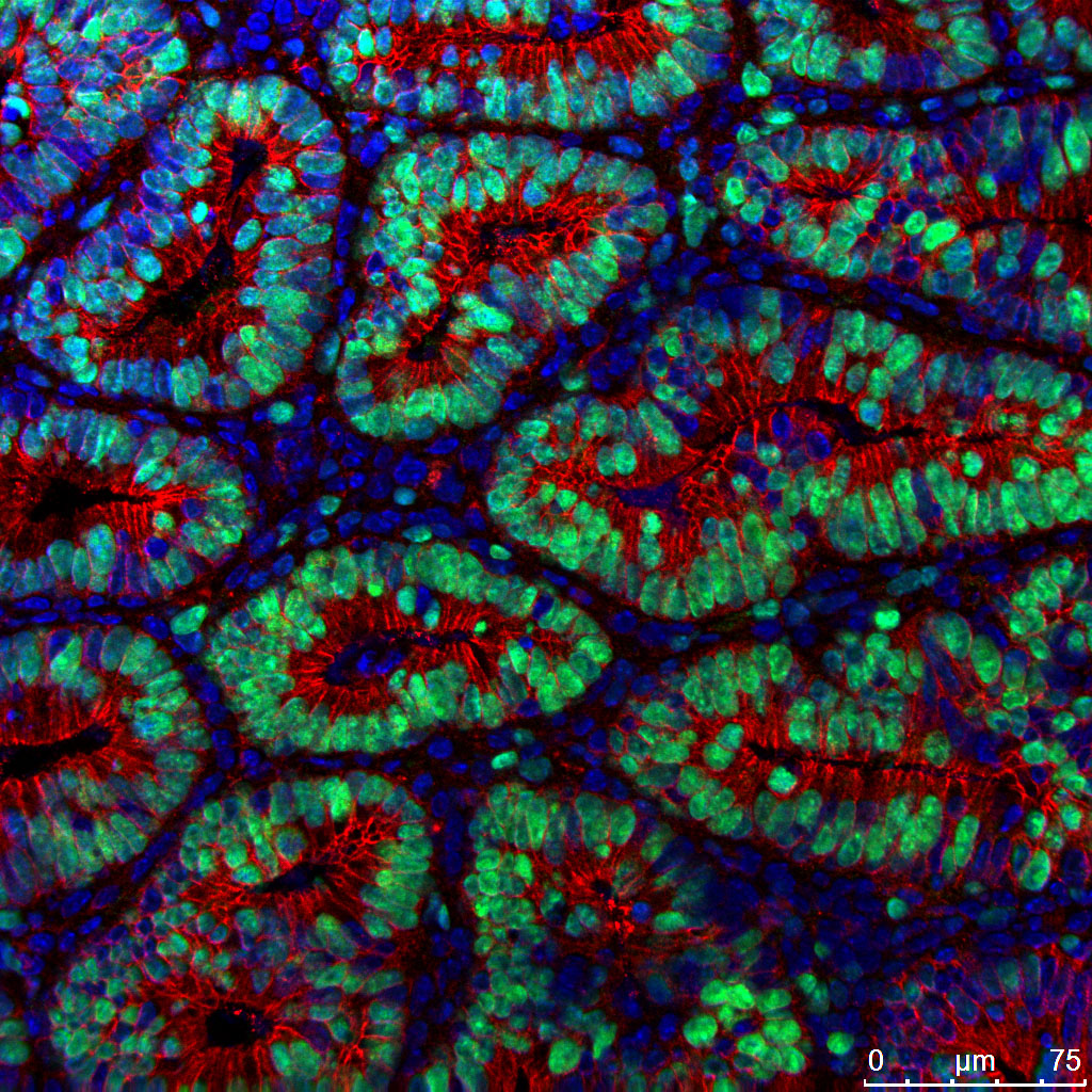 Colon tumor under fluorescent microscopy. Cells labeled with green dye are tumor cells. Cells labeled with blue dye are inflammatory cells.