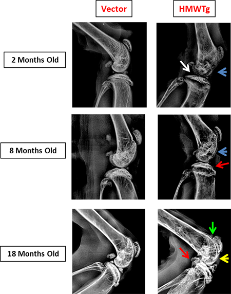 Knees of HMWFGF2Tg mice show changes in subchondral bone that mimic the progression of human osteoarthropathy in XLH subjects