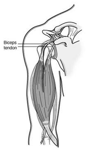 Biceps Tendonitis, Figure 1