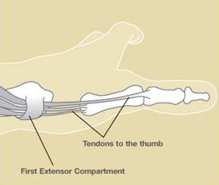 deQuervain’s Tendonitis, Figure 1A