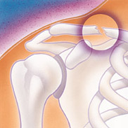 Fractured Collarbone and AC Joint Separation