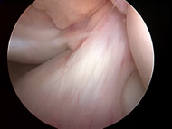 ACL Tears, Figure 1A