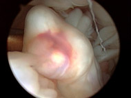 ACL Tears, Figure 1B