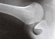 Shoulder Dislocation/Instability, Figure 1A