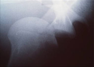 Shoulder Dislocation/Instability, Figure 1B