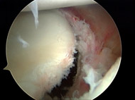 Shoulder Dislocation/Instability, Figure 2