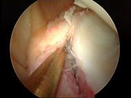 Shoulder Dislocation/Instability, Figure 3B