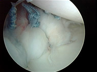 Shoulder Dislocation/Instability, Figure 3C