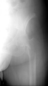 Figure 1: A radiograph of a destructive pathological fracture on the left hip, in a man with metastatic kidney cell cancer