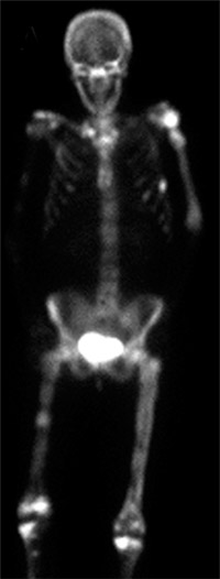 Metastatic Bone Disease  UConn Musculoskeletal Institute