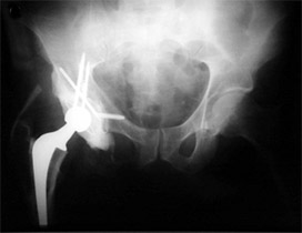 Figure 3: A 57 year old man with metastatic kidney cancer and progressive right hip pain requiring a special form of total hip replacement.