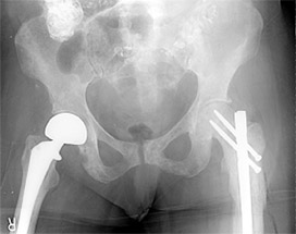 Figure 5: A woman with advanced metastatic breast cancer to bone with pain in both her right and left hips required different types of surgery to address her problems. A special partial hip replacement was necessary on the right because the hip joint was involved. On the left a special nail could be used to strengthen the femur bone below the hip.  Reproduced with permission from Weber K., Lewis V., Randall R.L., Lee A.K., Springfield D.: An Approach to the Management of the Patient with Metastatic Bone Disease, in Helfet DL, Greene WB (eds): Instructional Course Lectures, Volume 53, Rosemont, IL, American Academy of Orthopaedic Surgeons, 2004, p.663-676.