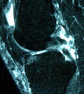 Multiple Knee Ligament Injury, Figure 1A
