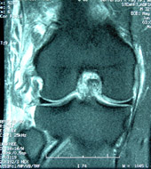 Multiple Knee Ligament Injury, Figure 1B