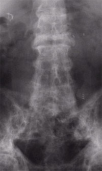 Figure 3: Paget's disease of the spine. The white, patchy appearance of the bone on this X-ray is characteristic of the dense but disordered bone in this disease.