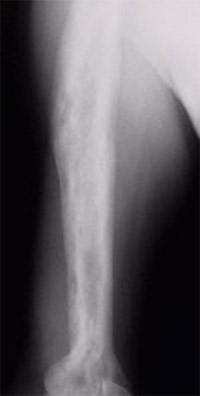 Figure 5: Paget's disease of the humerus. Note how dense and wide the bone is. It is also patchy from areas of active bone turnover.