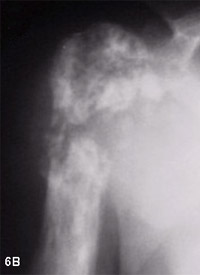 Figure 6: Paget's sarcoma of the humerus. There has been a significant change over time in the X-ray appearance from 6A to 6B. There is actual bone destruction in the later X-ray (6B) and there was a large soft tissue mass outside of the bone on the MRI.