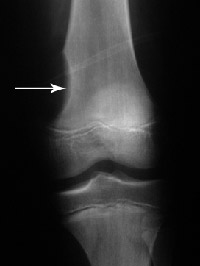 Figure 1a: Shows a tumor causing a saucer-like erosion in the end of the thighbone.