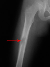 Figure 2a: Shows a bone tumor in the middle of the femur exhibiting a combination of characteristics.