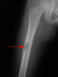 Benign and Malignant Bone Tumors | UConn Musculoskeletal Institute