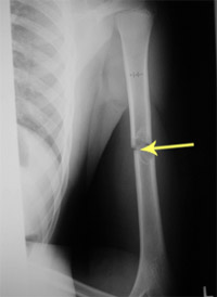 Figure 3: Shows a fracture through a tumor in the middle of the upper arm bone.