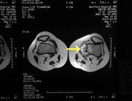 Figure 1b: Shows the cross-sectional MRI appearance of the tumor seen in Figure 1a.
