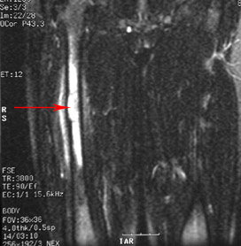 The MRI corresponding to the X-ray seen in Figure 2a is seen in Figure 2b (coronal view) and Figure 2c (cross-section).