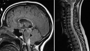 MRI scans showing neuromyelitis optica