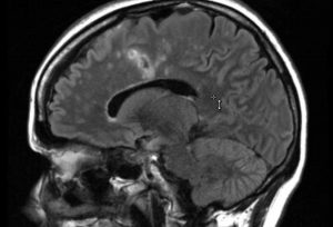 MRI showing Susac syndrome