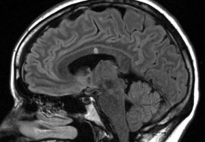 MRI showing Susac syndrome
