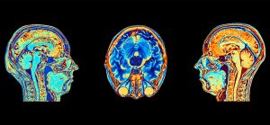 MRI scans of normal brains