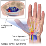 Carpal Tunnel (A.K.A. My Hand is Numb, Tingly, and I Can’t Sleep ...