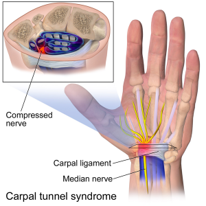 https://health.uconn.edu/orthopedics-sports-medicine/wp-content/uploads/sites/161/2018/02/600px-Carpal_Tunnel_Syndrome-300x300.png