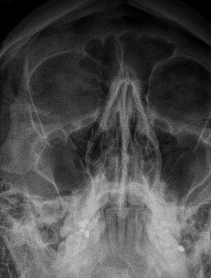 X-ray showing broken nose