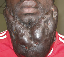 Can monkeypox cause keloid scars?