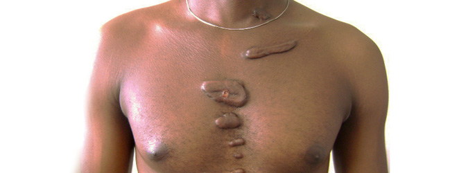 Keloids on a man's chest