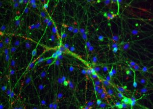 IPSC-derived neuron immunolabeled with neuronal marker TUJ1 and synaptic marker PSD-95.