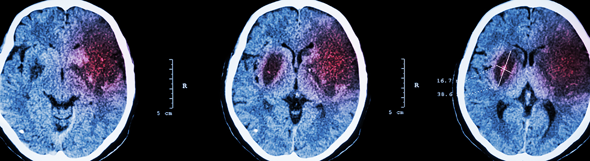 CT scan of brain