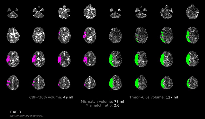 RapidAI software showing brain scan