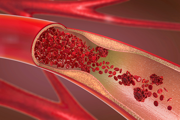 Illustration of a constricted and narrowed artery with blood clotting