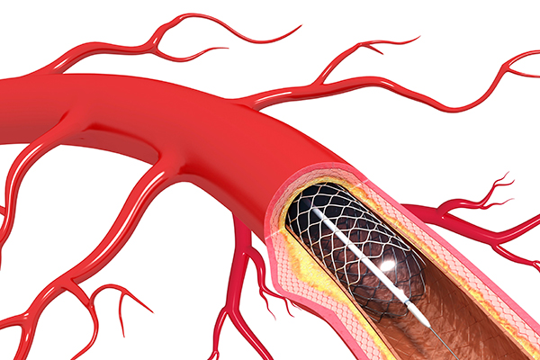 Stent used to open clogged artery