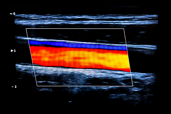 Ultrasound of carotid artery